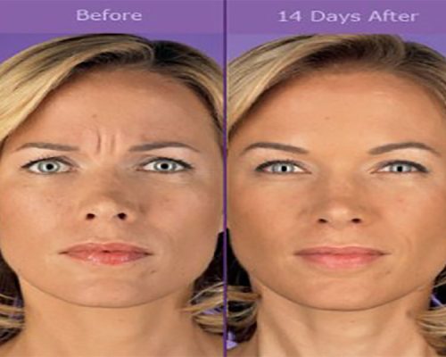 botox-1