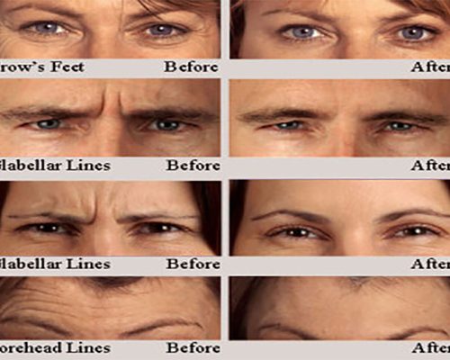 botox-before-after-effects