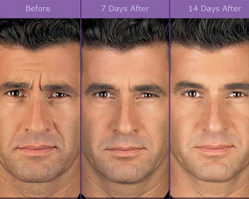 botox_beforeafter3