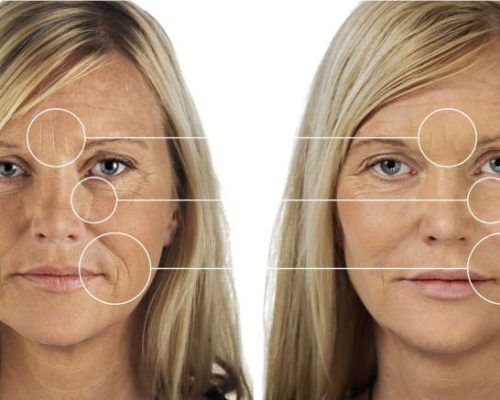 understanding-dermal-fillers-before-and-after
